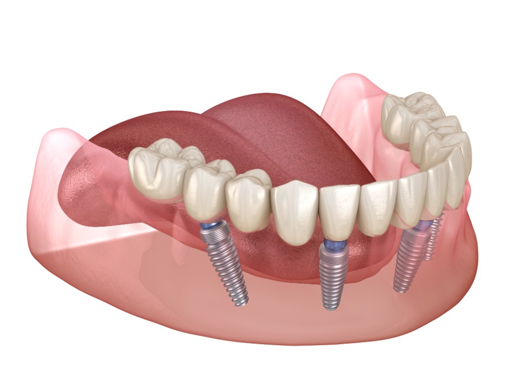 All-on-four implants