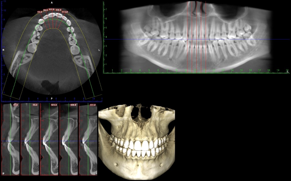 ct scan